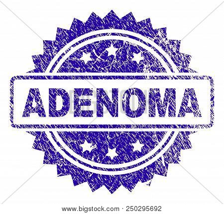 Adenoma Stamp Watermark With Grunge Style. Blue Vector Rubber Seal Print Of Adenoma Label With Uncle
