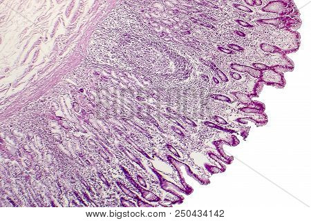 Intestinal Metaplasia Of Stomach, Light Micrograph, Photo Under Microscope