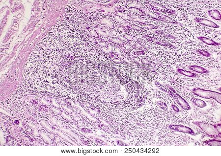 Intestinal Metaplasia Of Stomach, Light Micrograph, Photo Under Microscope