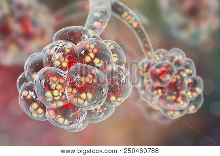 Pneumococcal Pneumonia, Medical Concept. 3d Illustration Showing Bacteria Streptococcus Pneumoniae I