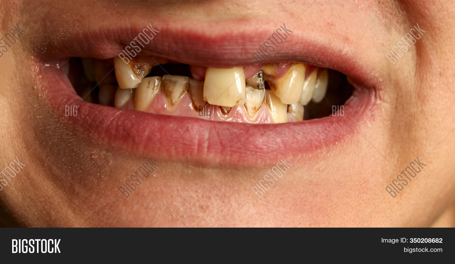 Open Mouth Broken, Image & Photo (Free Trial) Bigstock