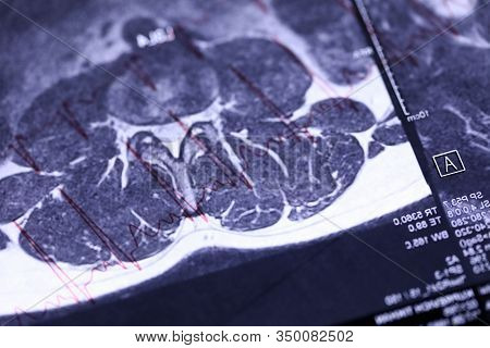 Close-up Of X-ray Diagnostics Of Human Body. Skiagram With Detailed Information Of Patient. Magnetic