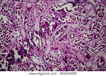 Histopathology Of Diffuse Sclerosing Glomerulonephritis, Light Micrograph, Photo Under Microscope