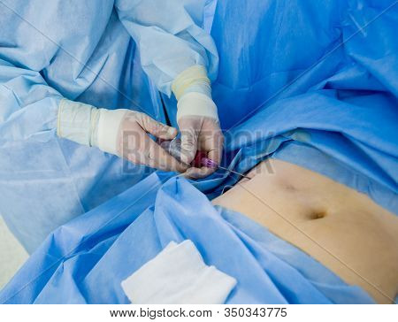 Arthroscope Surgery. Orthopedic Surgeons In Teamwork In The Operating Room