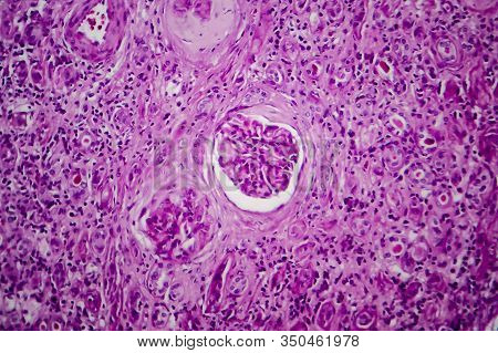 Chronic Glomerulonephritis, Light Micrograph, Photo Under Microscope