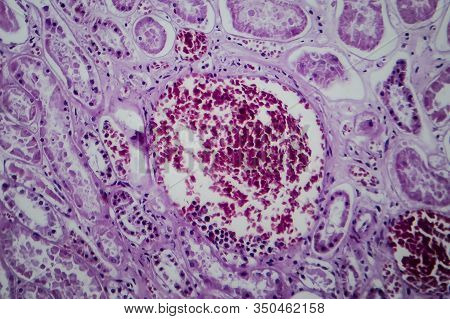 Acute Glomerulonephritis, Light Micrograph, Photo Under Microscope