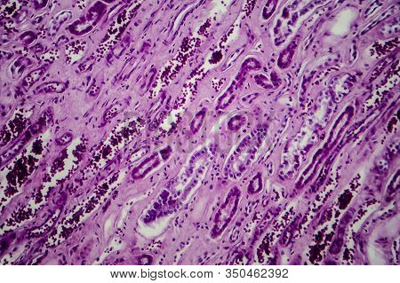 Diffuse Proliferative Glomerulonephritis, Dpgn, Light Micrograph, Photo Under Microscope