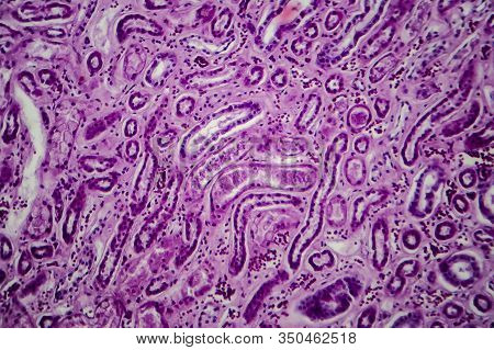 Diffuse Proliferative Glomerulonephritis, Dpgn, Light Micrograph, Photo Under Microscope