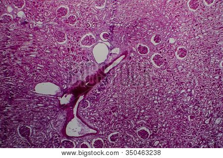 Histopathology Of Diffuse Sclerosing Glomerulonephritis, Light Micrograph, Photo Under Microscope