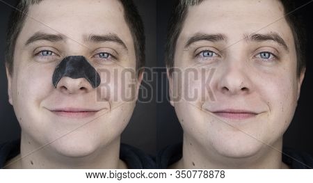 A Man Puts On And Removes A Strip For The Nose From Black Dots. Coal Cleaning Strips From Blackheads