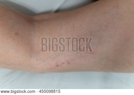 Removal Of Blood Vessels By Laser Vessel Venous Disease, Varicose Problem Patient Close Vein, Cutout