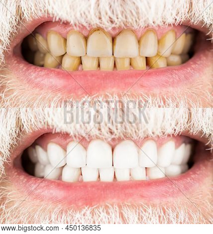Male Teeth Before And After Whitening, Oral Care Dentistry, Stomatology. Smiling Man Before And Afte