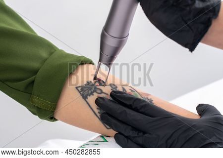 Cosmetologist Removing Tattoo With Laser Device Female Hand. Concept Of Erasing Tattoos As An Expens