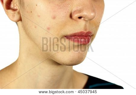 Ragazza con teste nere e cattivo della pelle Acne