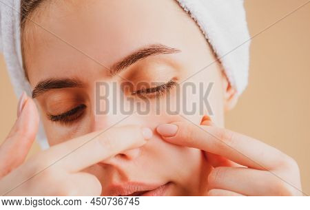 Girl Squeezing Pimples On Face. Acne Blemish Spots Skin On Young Woman. Spot Scar Acne, Freckles, An
