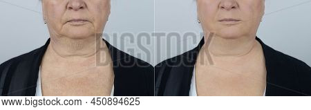 Senior Woman Shows The Result Facelift. Removal Wrinkles Around Mouth. Corners Mouth. Fight Against 