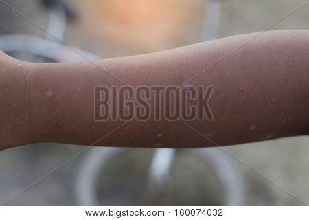 Little wound in the arm. No medical aid needed with selective and soft focus.