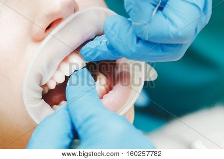 Close up of female mouth with retractor. Doctor flossing the teeth.
