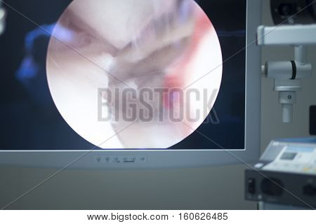 Arthroscopy Surgery Screen