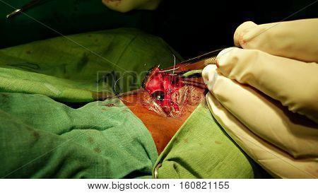 Z plasty eyelid surgery. Z- shaped incision. Surgery field. Different steps for this surgery