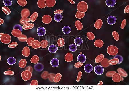 Acute Lymphoblastic Leukemia, Blood Smear, 3d Illustration
