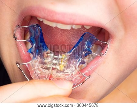 Patient Photo Of Teeth With Orthodontic Braces. Wearing Of Braces Is Very Popular Solution For Fixin