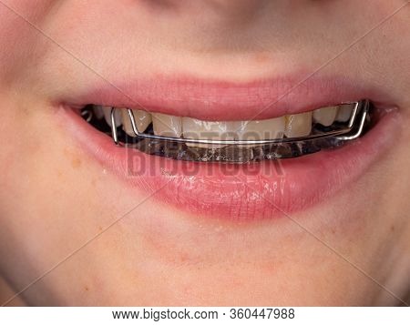 Teenage Boy Wearing Orthodontic Braces And Showing Tongue.  Teeth With Orthodontic Brackets. Dental 