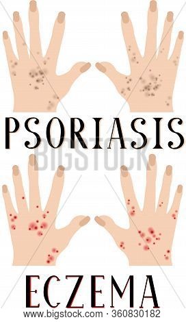 Psoriasis And Eczema. Diseased Skin. Sore Hands. Medical Poster. Dermatology And Venereology.