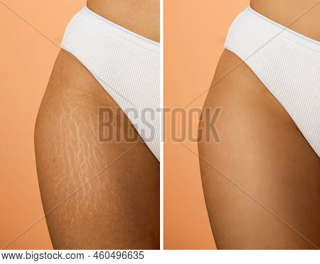 Image Compare Before And After Woman Legs With Stretch Marks Removal Treatment, Real People. Skin Ca