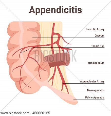 Appendix. Anatomical Diagram With Large Intestine, Caecum And Ileum.