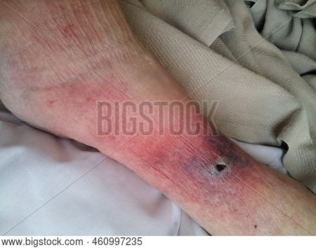 Streptococcal Cellulitis, Lymphangitis, Ulceration And Necrosis Of Leg