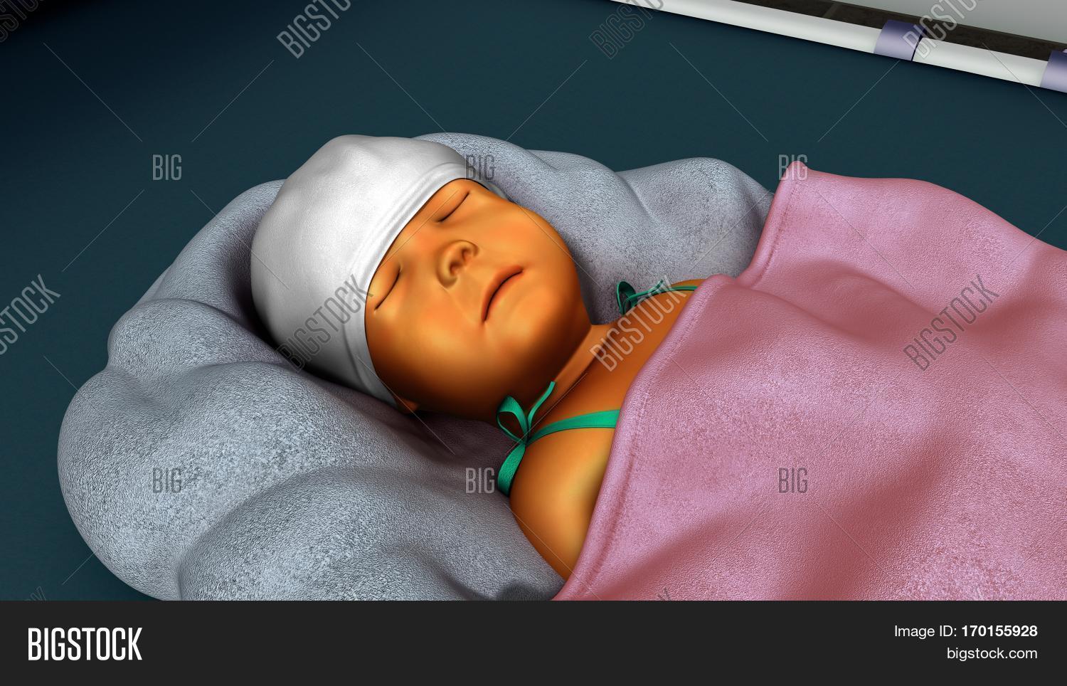 How To Get Rid Of Yellow Eyes In Newborns TeethWalls