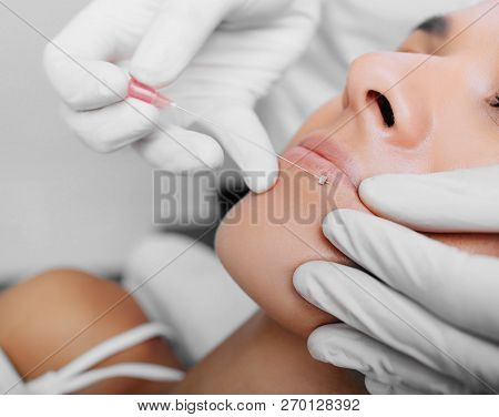 Aesthetic Face Surgery, Cosmetic Technique, Mesothreads Lifting And Contouring Face