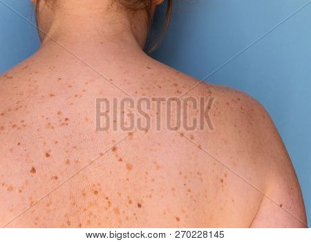 Closeup Of Freckles On The Back Of A Woman. Pigmentation And Lot Of Birthmarks. Skin Problems. Stock