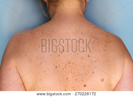 Closeup Of Freckles On The Back. Pigmentation And Lot Of Birthmarks. Skin Mole Problems. Stock Image