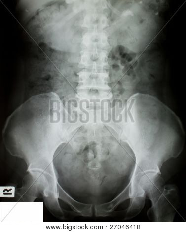 X-Ray van het bekken en de wervelkolom.