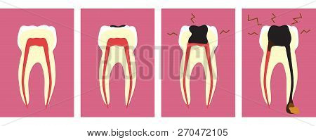 The Destruction Of The Tooth And As A Result Pulpitis. Phased Illustration.