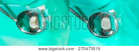 Human Teeth Close-up During Restoration Of Filling. The Concept Of Aesthetic Dentistry