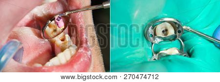 Endodontic Treatment Of Teeth Close-up. Cleaning Of The Roots Of The Teeth And Their Filling. The Co
