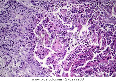 Squamous Cell Carcinoma Of The Lung, Light Micrograph, Photo Under Microscope