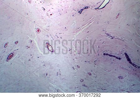 Uterus Adenofibroma, Light Micrograph, Photo Under Microscope. A Rare Benign Tumor Of The Uterus Com