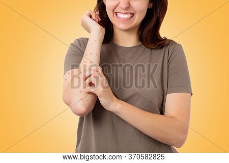 Scabies. Close Up Portrait Of A Caucasian Young Woman Scratching Her Hand Covered In A Red Rash. Yel
