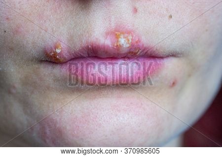 Herpes Disease On The Lips Of A Young Girl. Wounds From Herpes On The Lips Of A Person. Herpes Foci.