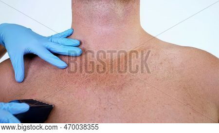 Close-up, Cosmetologist Female Hands In Gloves Haircut Body Hair Of A Naked Hairy Man, His Chest, To