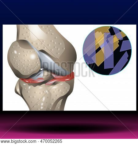 Knee Bone With Cpp Crystals - - Acute Calcium Pyrophosphate (cpp) Crystal Arthritis Is A Condition T