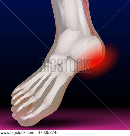 Toe Bone - Fractures Of The Toes And Forefoot Are Quite Common. Fractures Can Result From A Direct B