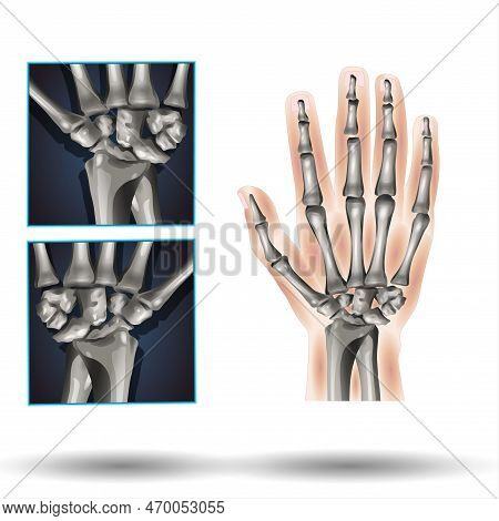 Wrist Anatomy - Bone, Scaphoid, Pisiform, Trapezium