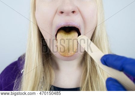 Woman Has A Yellow Tongue. Painful Yellow Coating On The Mucous Membrane Of The Tongue. Diseases Of