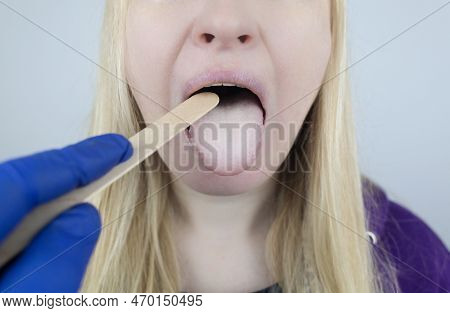Woman Has A Yellow Tongue. Painful Yellow Coating On The Mucous Membrane Of The Tongue. Diseases Of