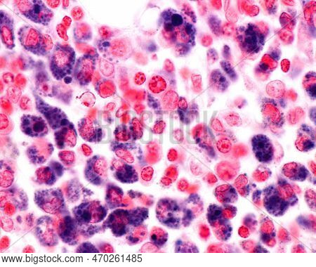 High Magnification Micrograph Showing Macrophages Of An Inflammation Zone Heavily Marked With Trypan